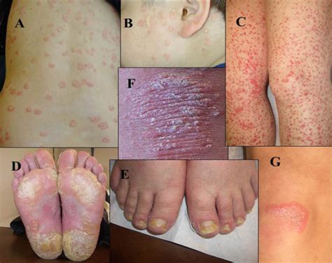 Celiac Disease And Associated Dermatitis Atlas Of Science