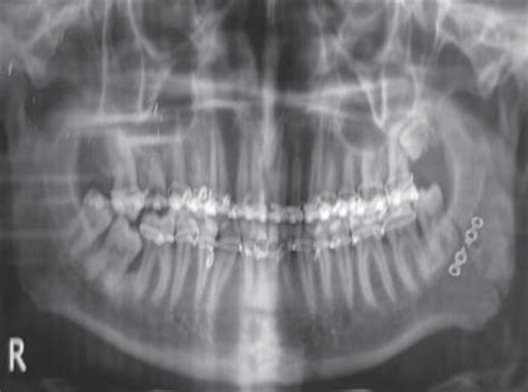 Mandibular Fracture X Ray