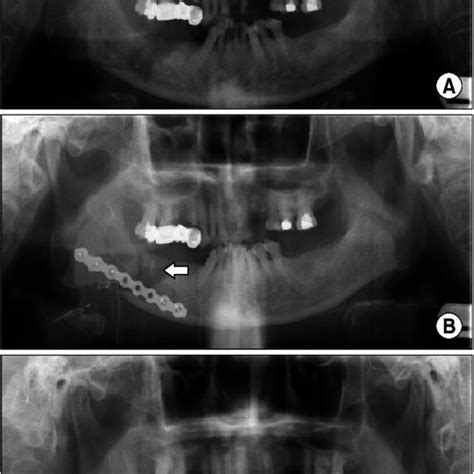 Mandible Fracture Resulting From Odontogenic Keratocyst A Panoramic