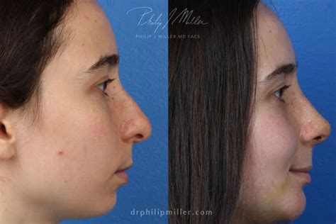 Droopy Nose How To Get A Pointy Nose Philip Miller Md