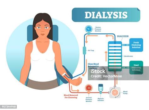 투 석 의료 절차 시스템 벡터 일러스트 레이 션 다이어그램입니다 신장 기능 상실의 경우 혈액을 필터링합니다 투석에 대한 스톡