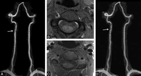 Vertebral Artery Dissection Mri