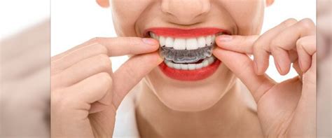 Invisible Braces For Adults Dr Bhutani Dental Clinic In Delhi India