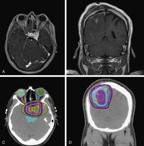 Benign Brain Tumors Meningiomas And Vestibular Schwannomas Clinical Tree