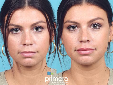 JUVÉDERM Before and After Pictures Case 802 Orlando Florida