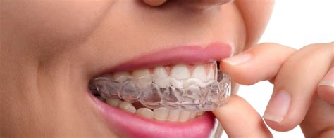 How To Properly Clean Your Invisalign Aligners