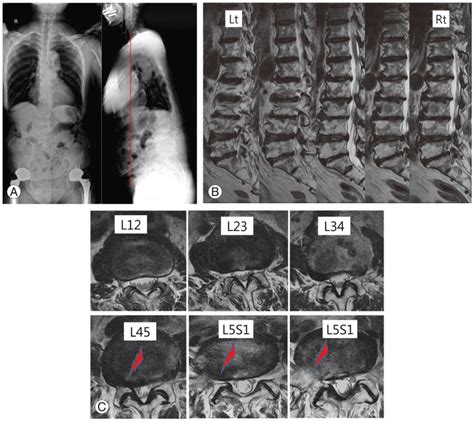 Radiograph And Magnetic Resonance Imaging Mri Showing Foraminal Download Scientific Diagram