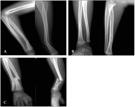 Greenstick Fracture Diagram