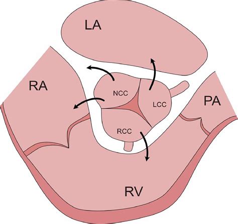 Sinus Of Valsalva Aneurysms A Review With Perioperative Considerations Journal Of