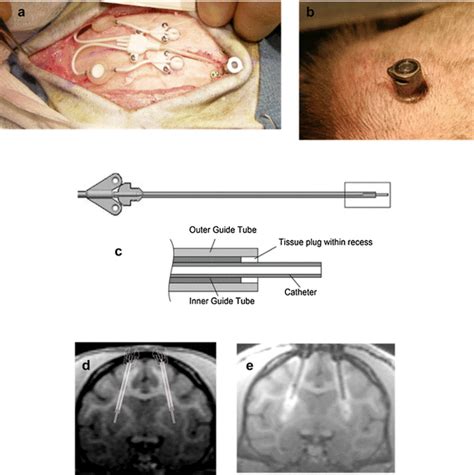 Drug Delivery System Dds A Surgical Site With Implanted