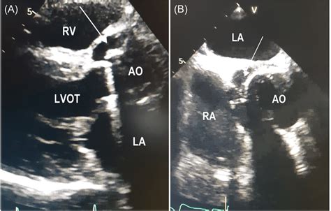 Preprocedural Echocardiographic Findings Preprocedural Transthoracic