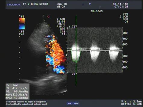 Pulmonary Valvular Endocarditis In The Patient With Pulmonary Stenosis A Case Report With Real