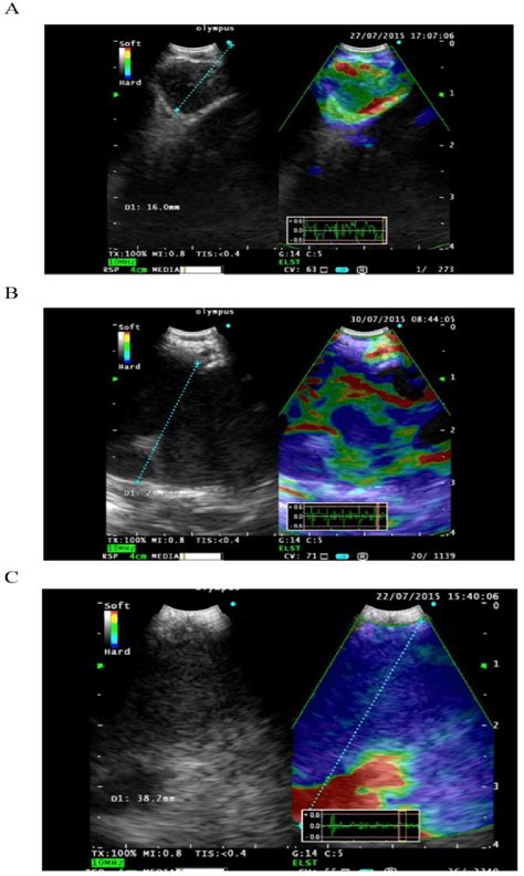 Elastography A Type 1 Predominantly Non Blue Green Yellow And