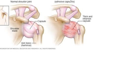 Capsulitis del dedo Cuánto tiempo tarda en sanar