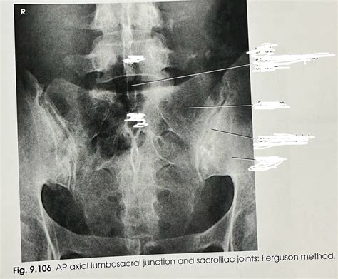 Ap Axial Lumbosacral Joint Diagram Quizlet