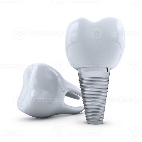 implant and molar 12717279 Stock Photo at Vecteezy