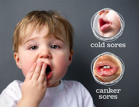 Cold Sore Vs Canker Sore On Lip