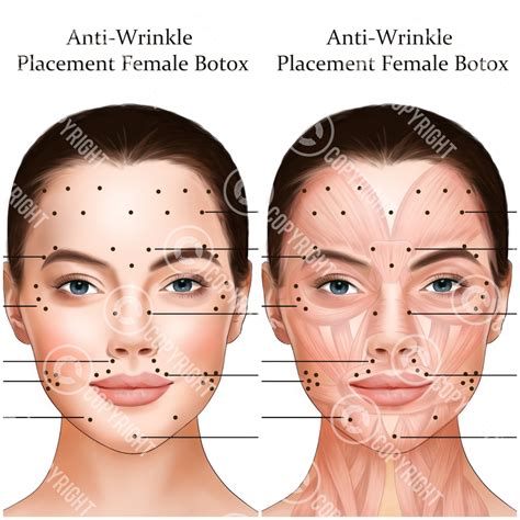 Botox Injection Points Bundle Botox Filler Injector Anatomy Art