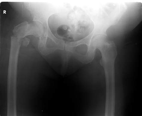 Understanding Bone Fracture X Rays