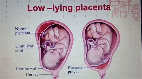 Retained Placenta 3 Weeks After Birth