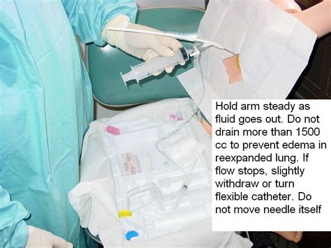 Thoracentesis Procedure Steps