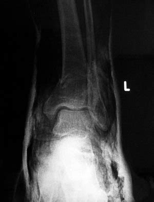 Left tarsal joint – fatigue fracture of left tibial bone treated by ...