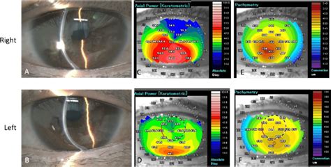 Findings Of Slit Lamp Microscopy And Corneal Topography At The Initial