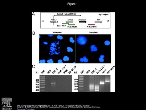 A Case Of Fip1l1 Pdgfra Positive Chronic Eosinophilic Leukemia With A