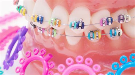 The Ultimate Braces Style Guide | Braces Style and Color