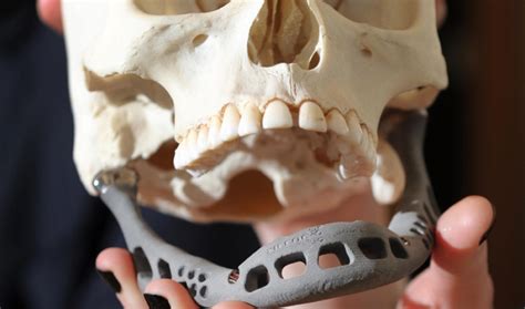 Man gets 3D printed skull implant | The World from PRX