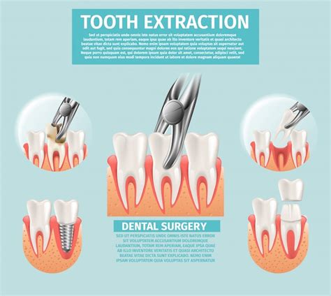 Premium Vector Realistic Illustration Tooth Extraction Vector D