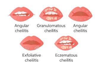 Exfoliative Cheilitis Lips Treatment | Lipstutorial.org