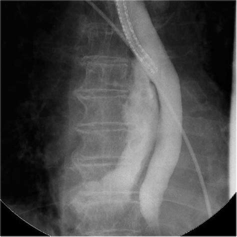 Fig Mucosa Of Lower Esophagus Showing Cm Ulcer With Ragged Edges And