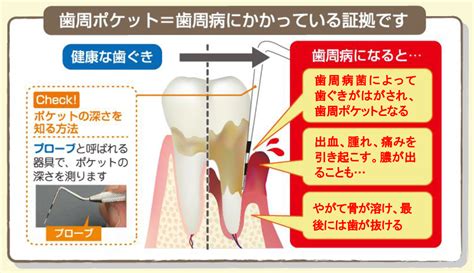 いまさら聞けない歯周ポケットの基本知識｜marimo Note｜逗子の矯正歯科・予防歯科 マリモ歯科・矯正