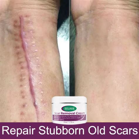 Scar Remover Peklat Remover Cream Original Peklat Remover For Old Scars