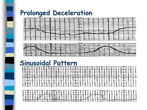 Ppt Fetal Monitoring Powerpoint Presentation Free Download Id 5180473