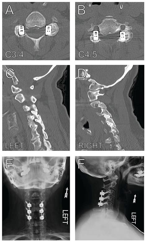 Preoperative And Postoperative Imaging After Removal Of Malpositioned