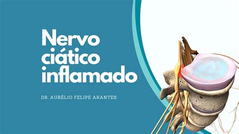 Nervo Ci Tico Inflamado Saiba Identificar E Como Tratar