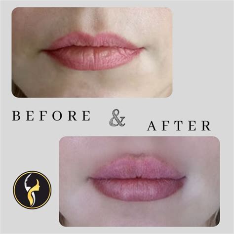 Lip Filler And Augmentation In Istanbul Turkey Dr Çiğdem Özden