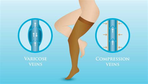 Compression Stockings For Varicose Veins All You Need To Know Dr