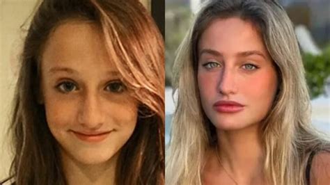 Cirurgias Antes E Depois De Bruna Griphao Do BBB 23