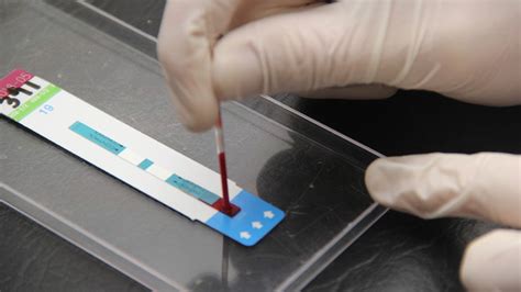 Cómo funciona el test rápido para detección de HIV