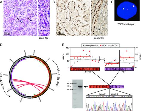 Identification Of Sfpq Tfe Gene Fusion In Renal Cancer A Histology