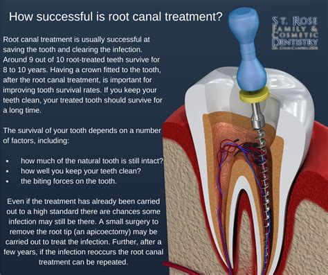 Root Canal Post Care Vbgarden