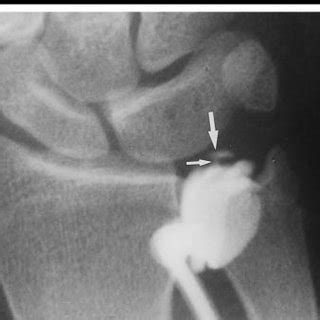 Drawing of a coronal wrist arthrogram demonstrates locations 1-5 ...