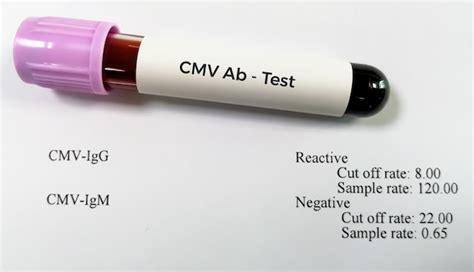 Premium Photo Blood Sample Tube For Cytomegalovirus Or Cmv Antibody