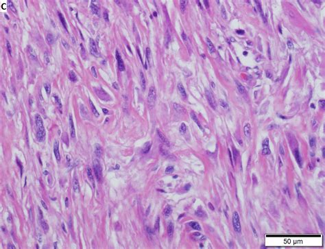 pleomorphic undifferentiated sarcoma libre pathology