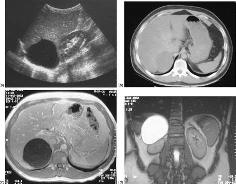 Imaging Features Of Benign Adrenal Cysts European Journal Of Radiology