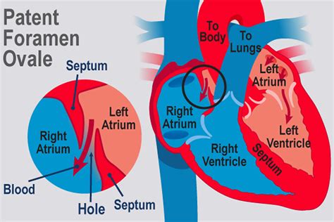 Pfo Heart Causes Symptoms Diagnosis And Pfo Heart Treatment