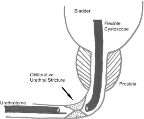 Figure From Internal Urethrotomy Combined With Antegrade Flexible